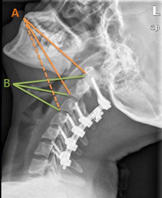 Reconstruction after resection of C2 vertebral tumors: A comparative study of 3D-printed vertebral body versus titanium mesh